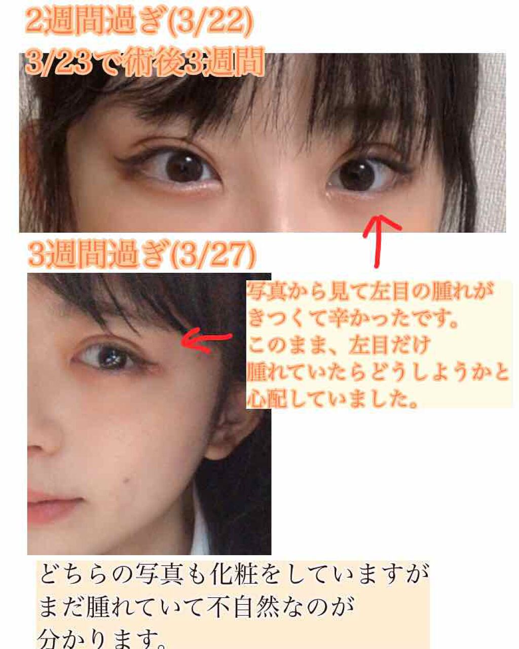 二重整形の口コミ 二重整形 埋没式 まとめ こんにちは 黄 By 黄鶲 敏感肌 代前半 Lips