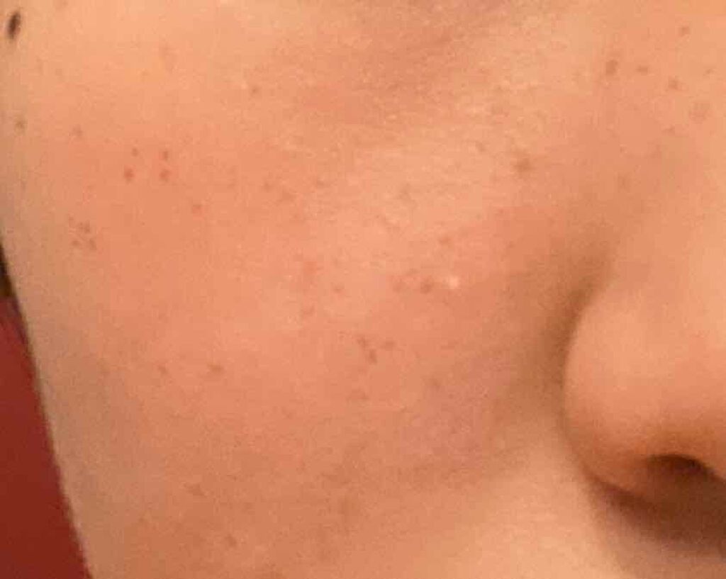 オロナインＨ軟膏 (医薬品)/オロナイン/その他を使ったクチコミ（3枚目）