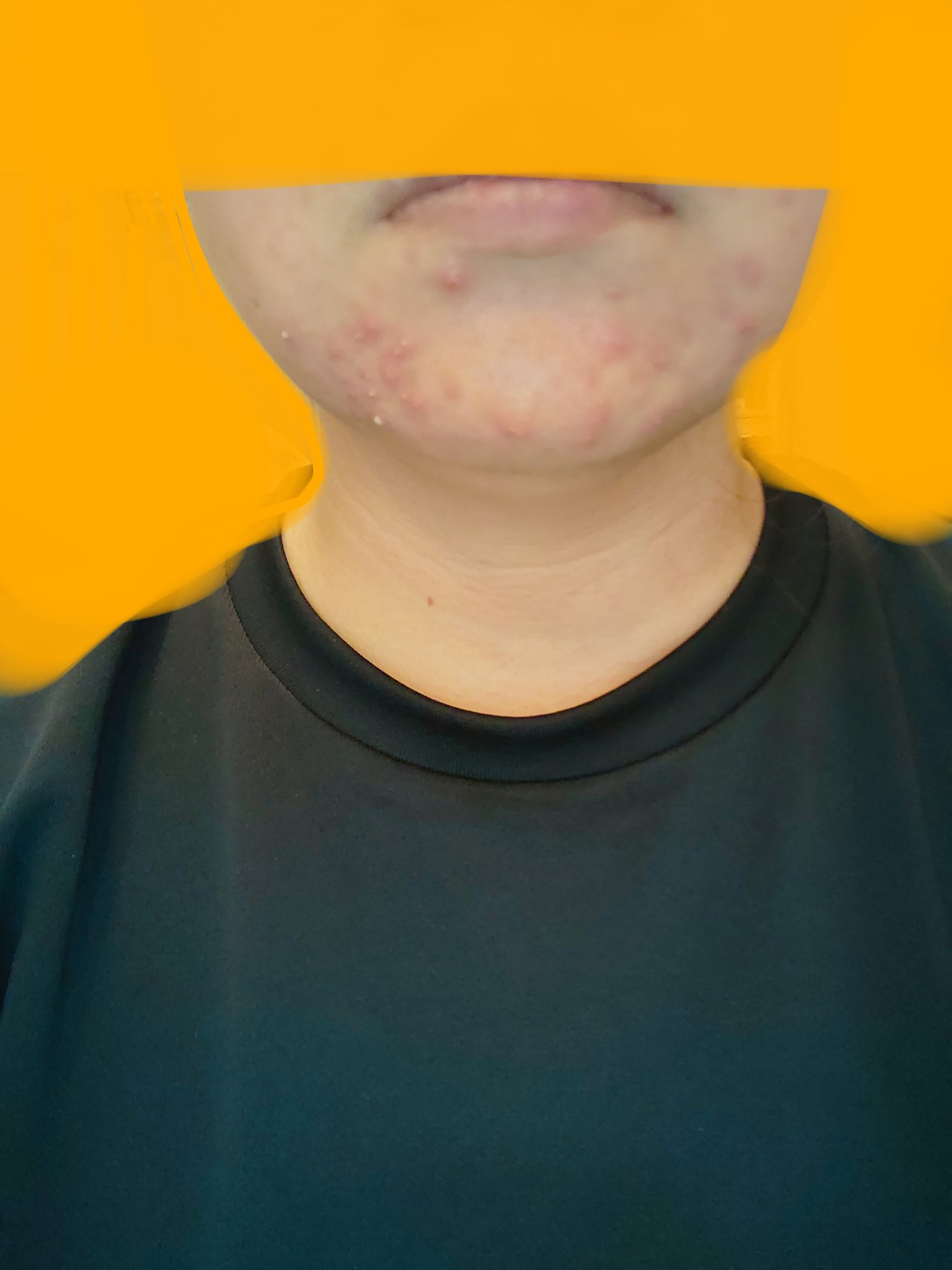 ごめんね素肌 キニナルマスク/クリアターン/シートマスク・パックを使ったクチコミ（2枚目）