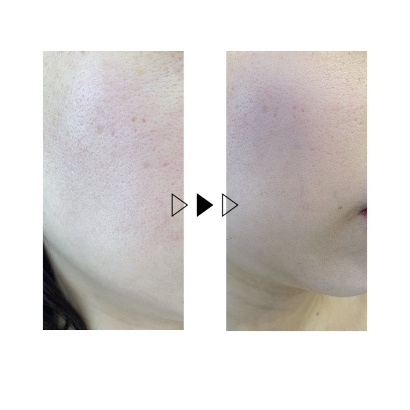 シカレチA エッセンス0.1/VT/美容液を使ったクチコミ(5枚目)