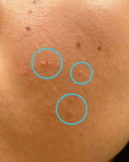 極薄透明パッチ nikipa!/金冠堂/にきびパッチを使ったクチコミ(4枚目)