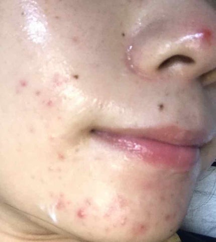 薬用 しみ 集中対策 美容液/メラノCC/美容液を使ったクチコミ(1枚目)