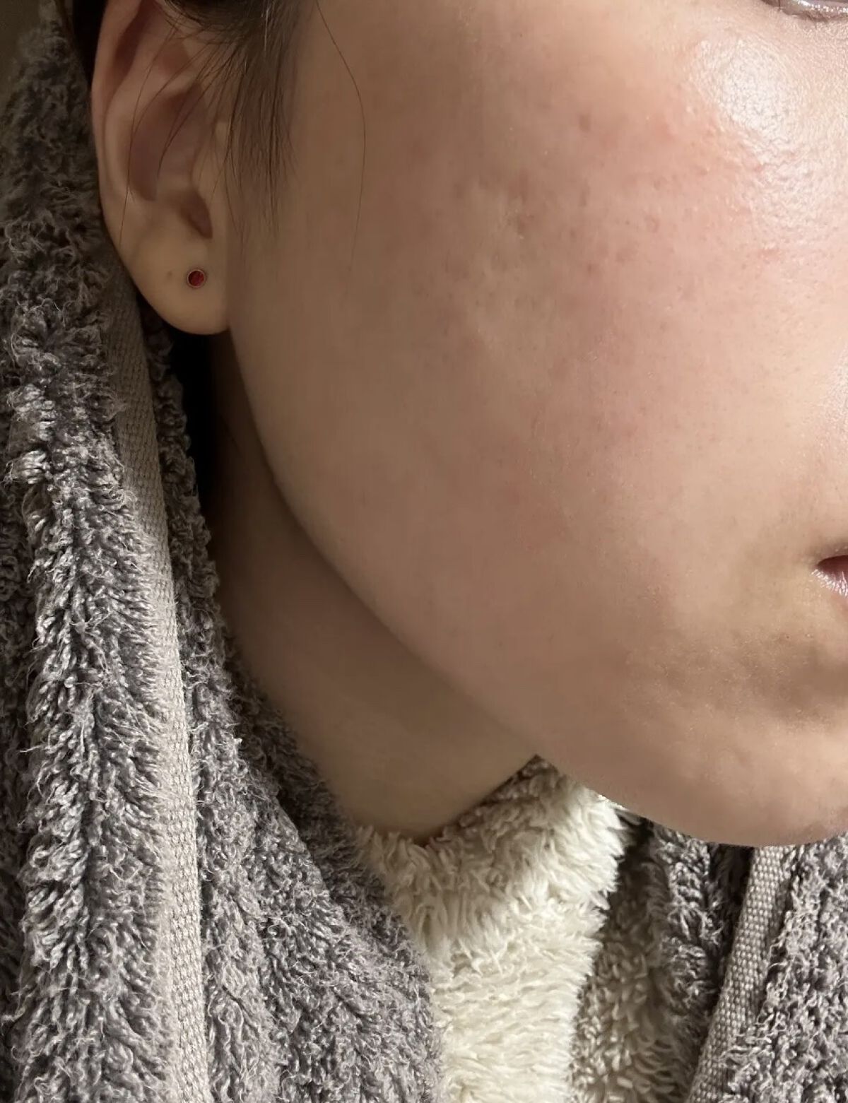 DRX AZAクリア/ロート製薬/その他スキンケアを使ったクチコミ（1枚目）