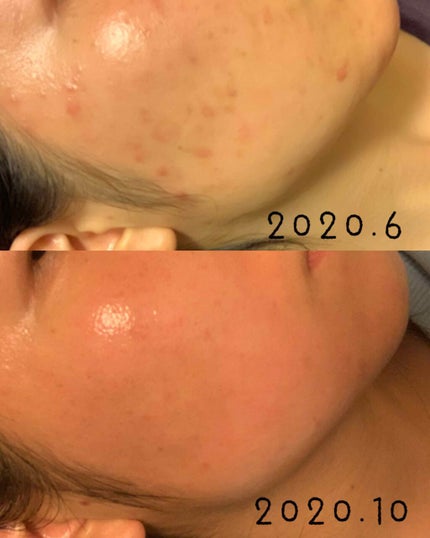 ミノン アミノモイスト モイストチャージ ミルク/ミノン/乳液を使ったクチコミ(3枚目)