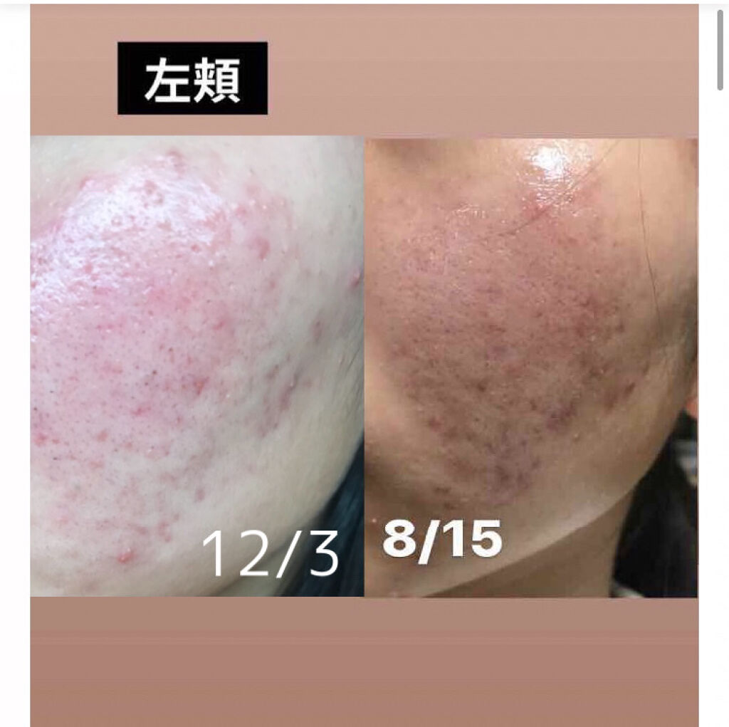 極潤ヒアルロン液（ハダラボモイスト化粧水d）/肌ラボ/化粧水を使ったクチコミ（2枚目）