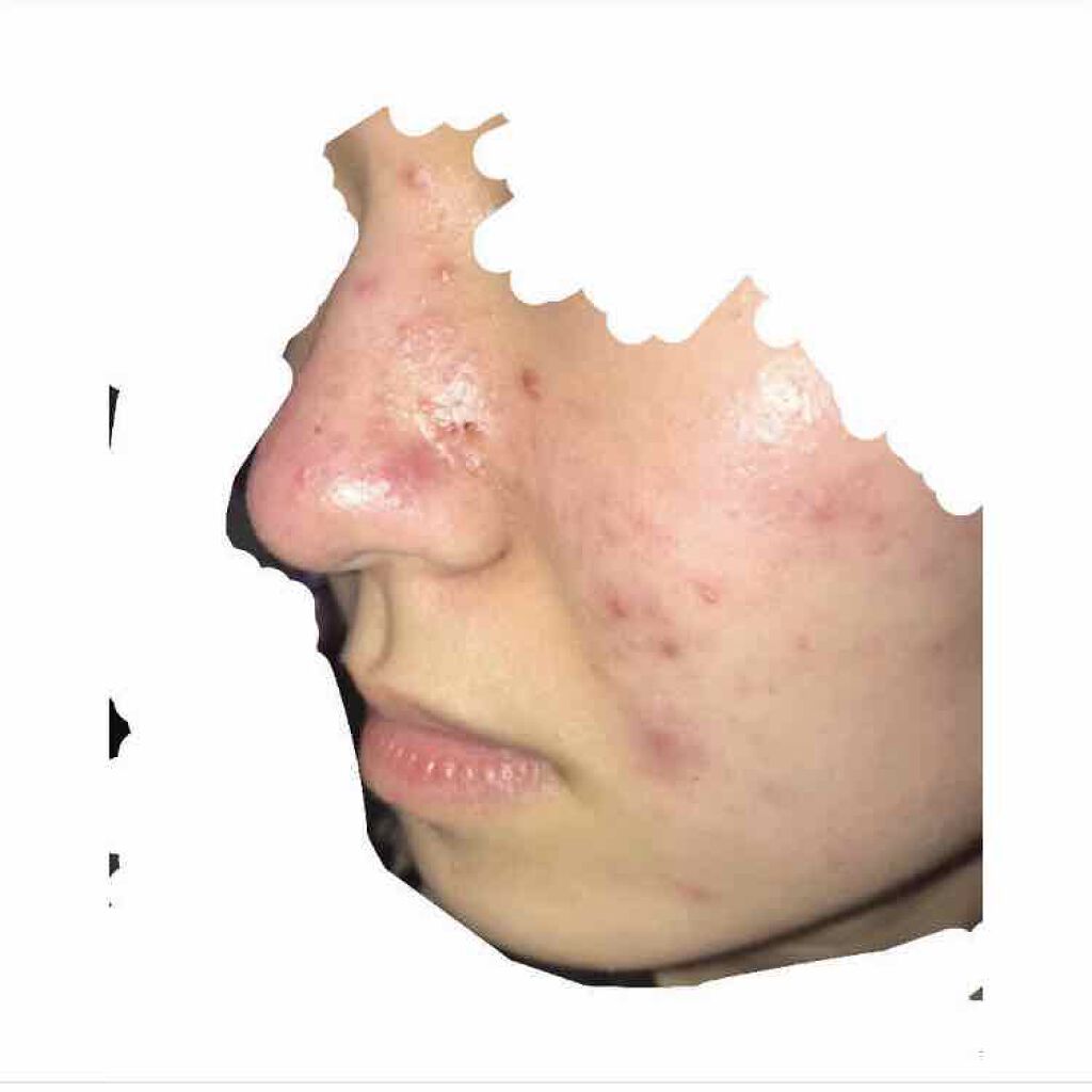 ノブ Ａ アクネソープ/NOV/洗顔石鹸を使ったクチコミ（2枚目）