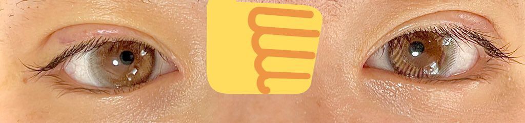 maringo22222 on LIPS 「ダウンタイム4日目痛み目やに消えた!でも片方だけやっぱ腫れてる..」(1枚目)