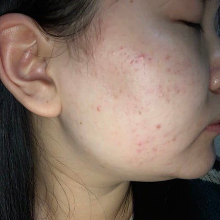 ティーツリーケア ソリューション エッセンシャルマスクEX/MEDIHEAL/シートマスク・パックを使ったクチコミ(2枚目)