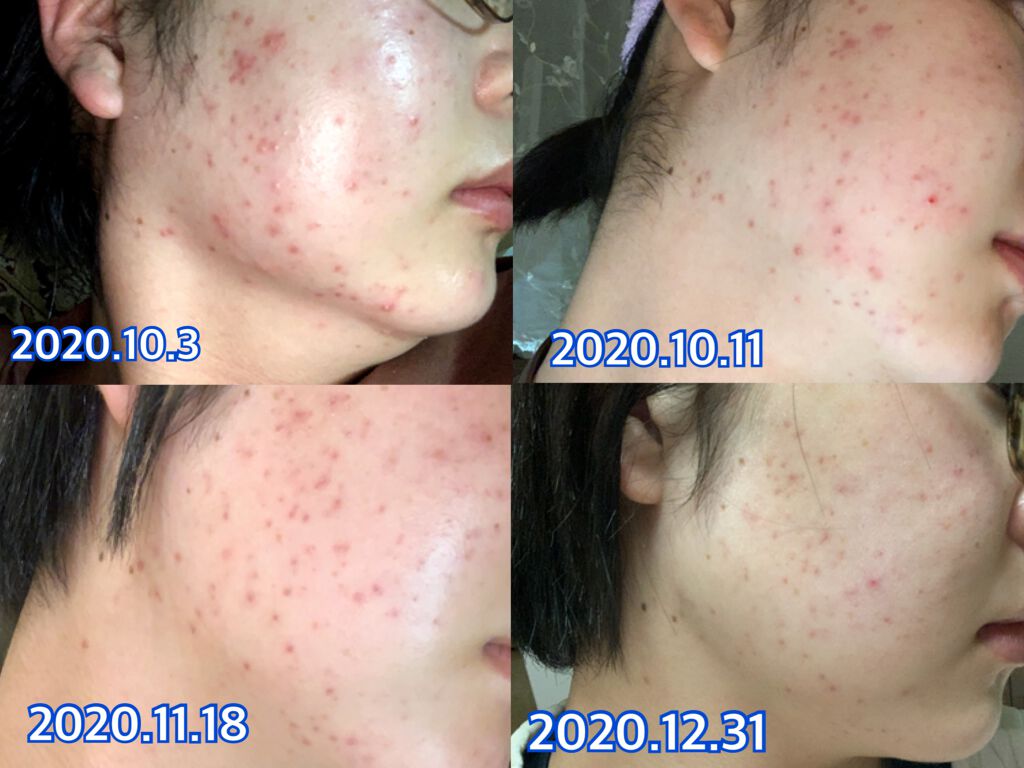 ホワイトケア トライアルセット/b.glen/スキンケアキットを使ったクチコミ(2枚目)