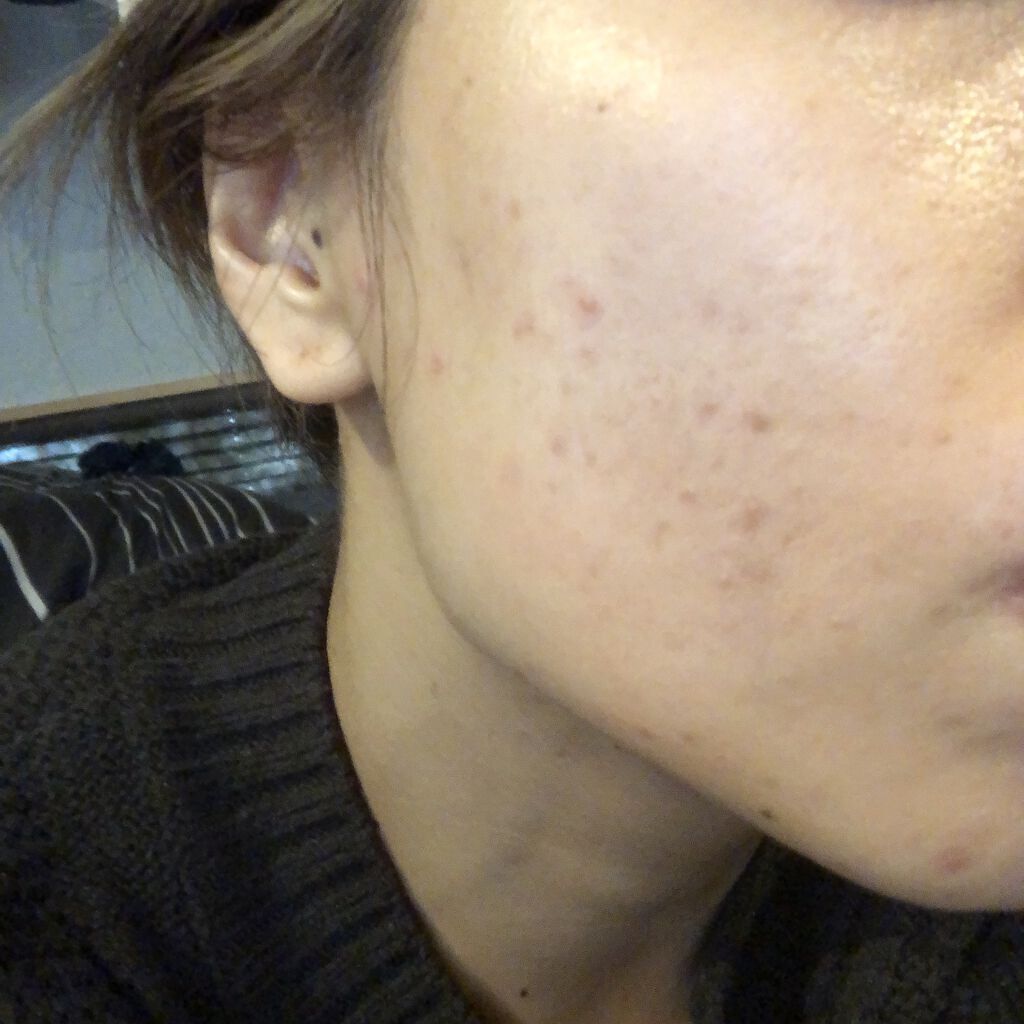 弱酸性pHシートマスク ドクダミフィット/Abib /シートマスク・パックを使ったクチコミ（3枚目）