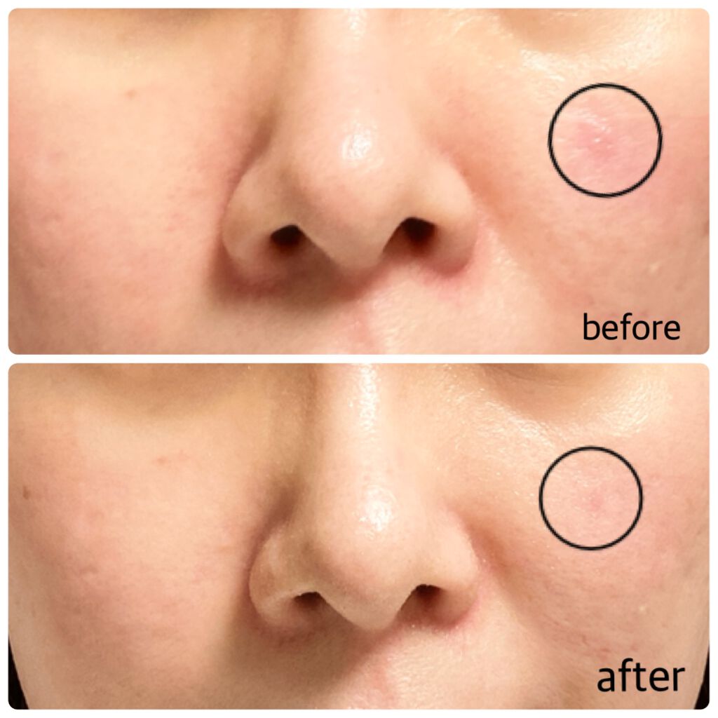 サンケファン水分マスク/ABOUT ME/シートマスク・パックを使ったクチコミ（3枚目）