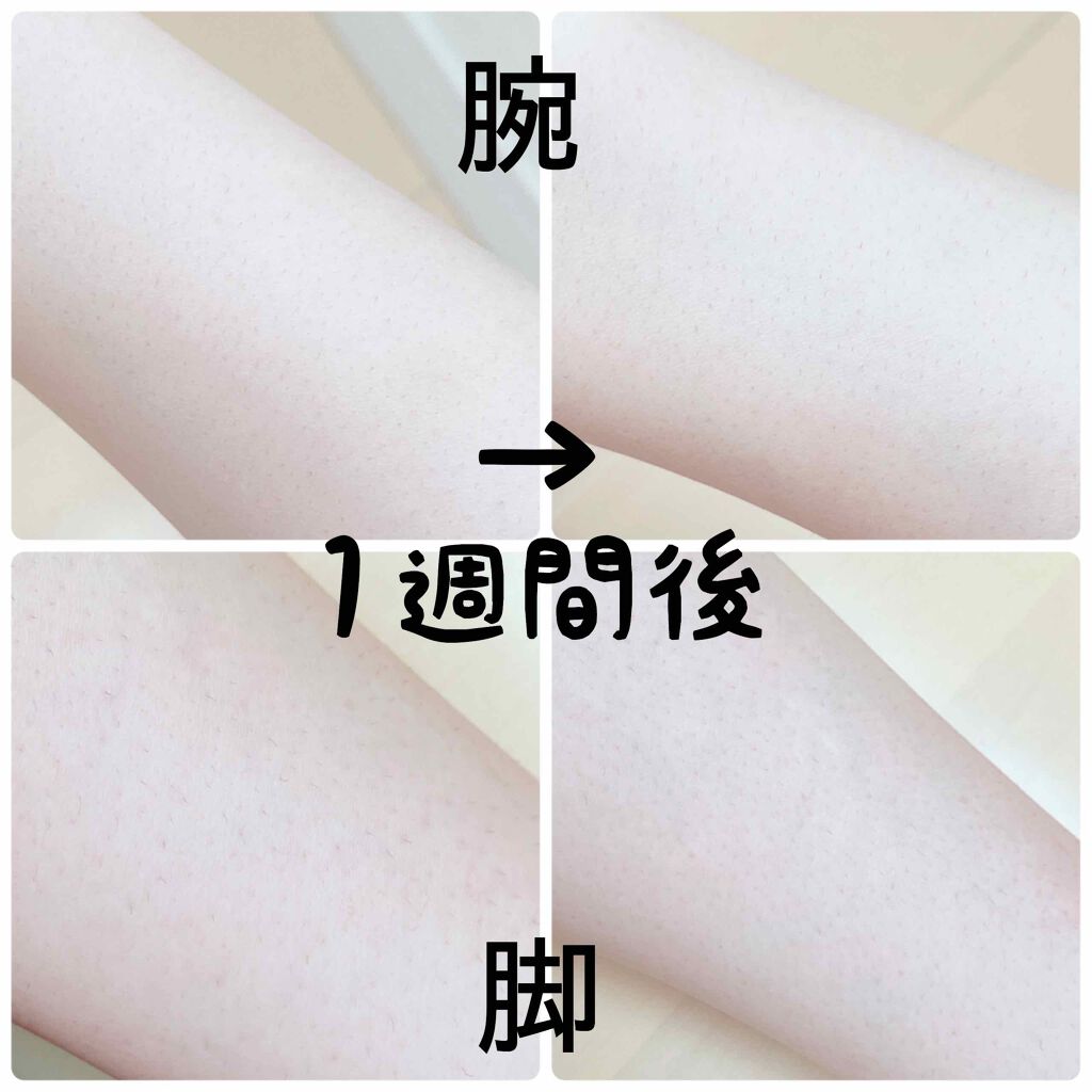 アイスレディ/icelady/家庭用脱毛器を使ったクチコミ(3枚目)