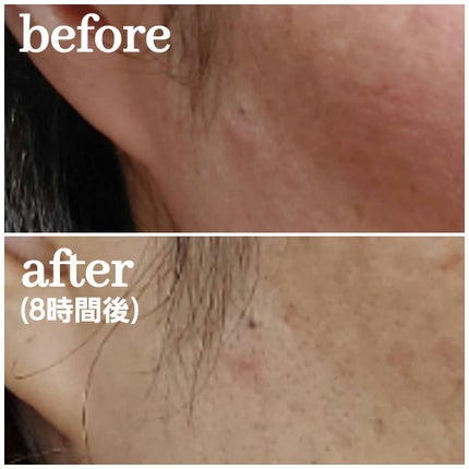 エーキュアショットスポットパッチ/obsero/にきびパッチを使ったクチコミ(5枚目)