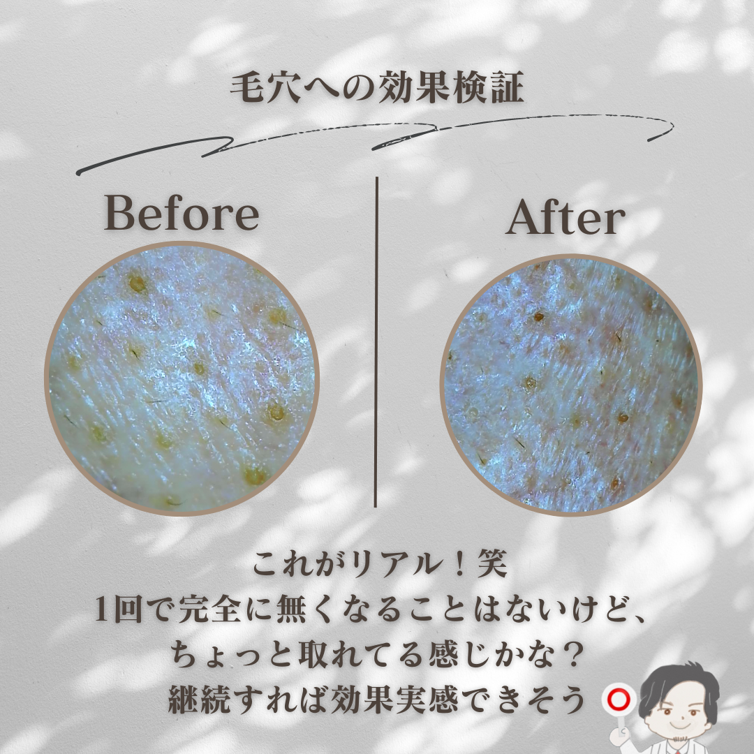 ブラックヘッドバームスクラブ/オブジェ/フェイスバームを使ったクチコミ(4枚目)