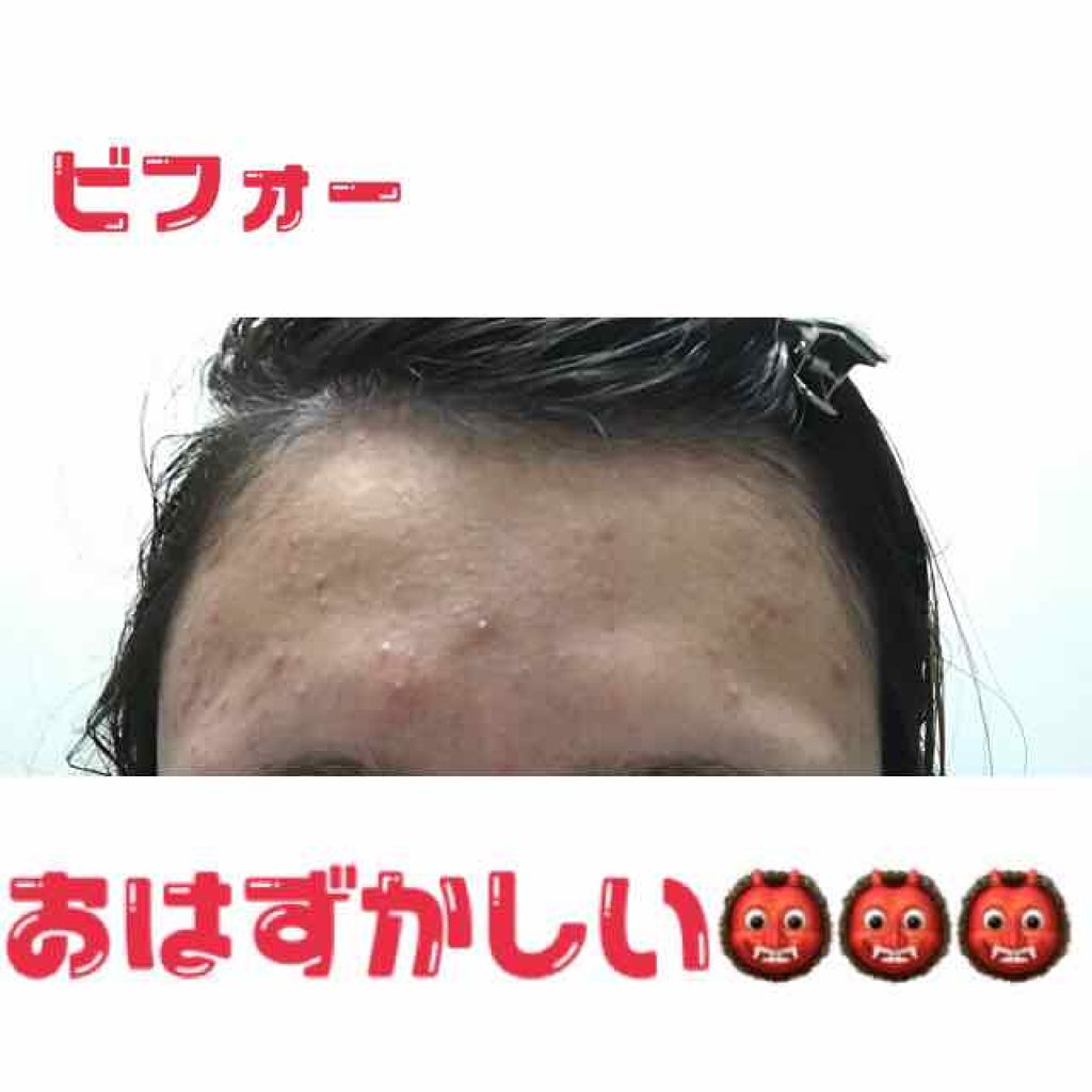 大人のニキビ対策 薬用集中保湿＆美白マスク/肌美精/シートマスク・パックを使ったクチコミ（2枚目）