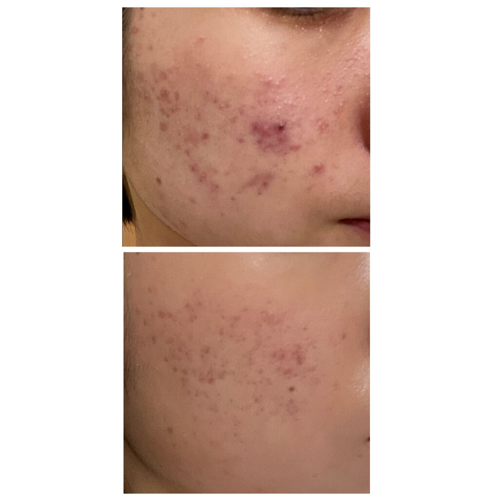 クリンダマイシンゲル(医薬品)/クラシエ薬品/その他を使ったクチコミ（2枚目）