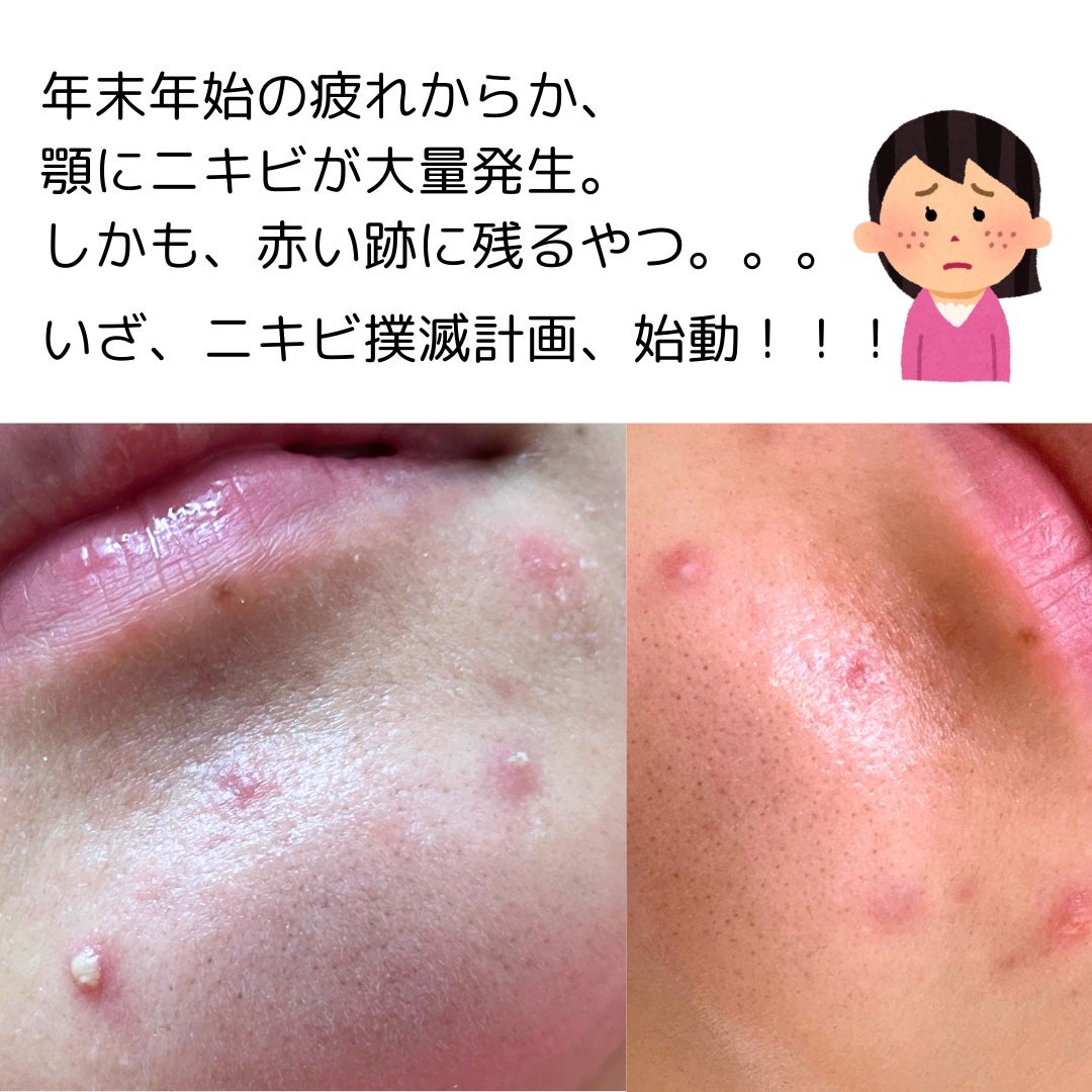 テラマイシン 軟膏(医薬品)/ジョンソン・エンド・ジョンソン/その他を使ったクチコミ(2枚目)