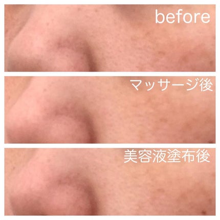 チョコブラ スペシャル毛穴ケアセット/Chocobra/スキンケアキットを使ったクチコミ(6枚目)