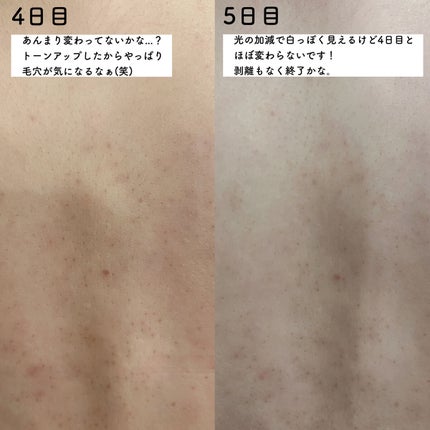 ダーマスキンピーリング/BQCELL/その他キットセットを使ったクチコミ(7枚目)