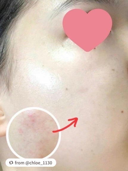 3ミニッツマスク:カーマイド with ティーツリー/MEDIHEAL/シートマスク・パックを使ったクチコミ(3枚目)