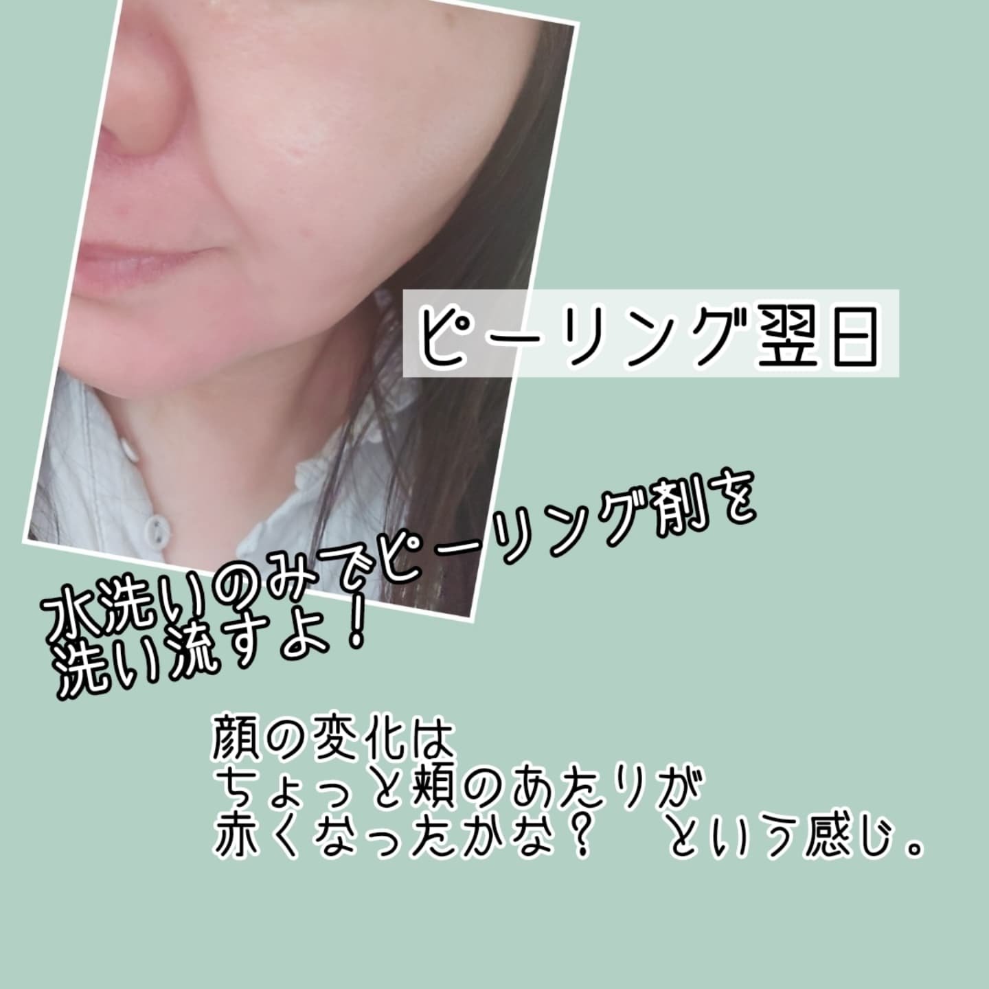 ダーマスキンピーリング/BQCELL/その他キットセットを使ったクチコミ（3枚目）