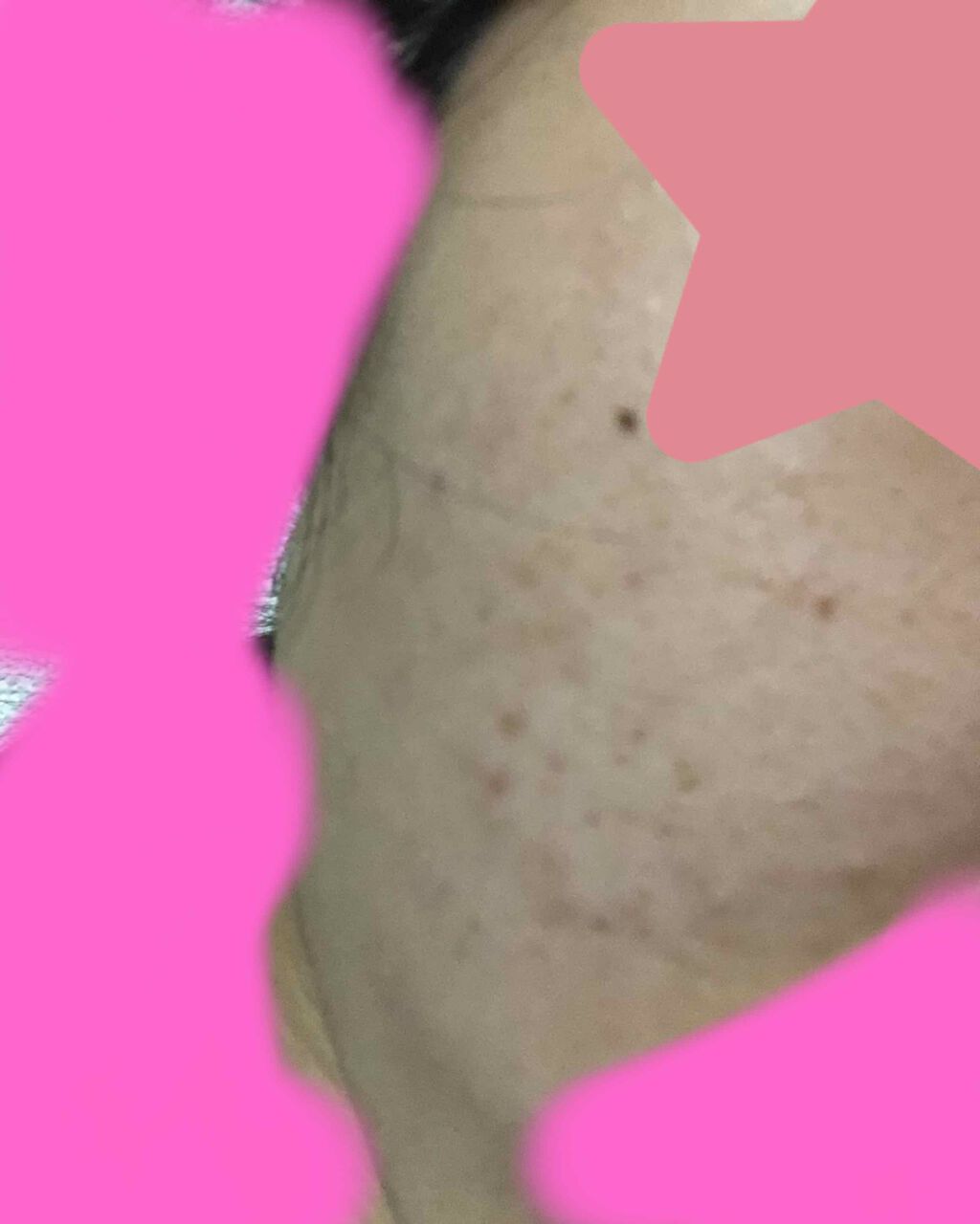 ニキビ治療薬クリーム (医薬品)/クレアラシル/その他を使ったクチコミ（2枚目）