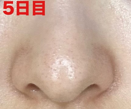 薬用 しみ 集中対策 美容液/メラノCC/美容液を使ったクチコミ(7枚目)