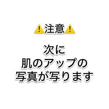 リッツ モイスト ローションのクチコミ「赤ら顔で悩んでいる人に使って欲しい化粧水😭✨
スキンケアする中で⚠️注意した点もご紹介👀

*.....」（2枚目）