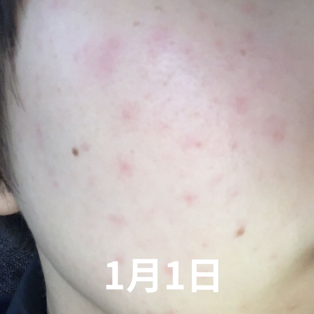 プリスクリードD(医薬品)/IHADA/その他を使ったクチコミ（2枚目）