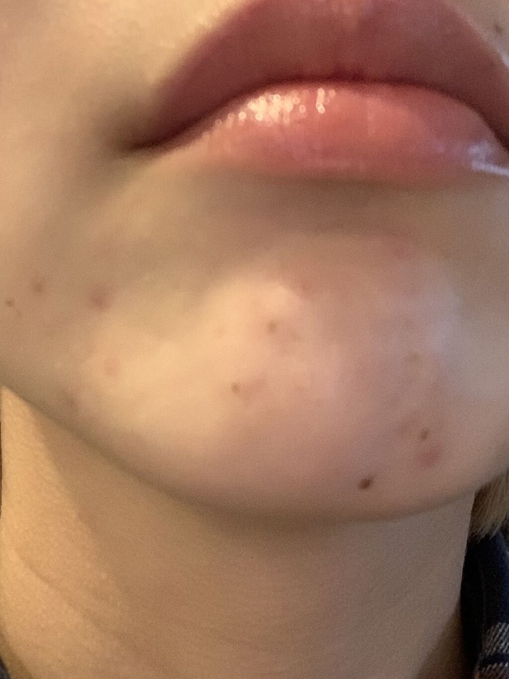 ピアソンＨＰクリーム(医薬品)/ピアソンHP/その他を使ったクチコミ（3枚目）