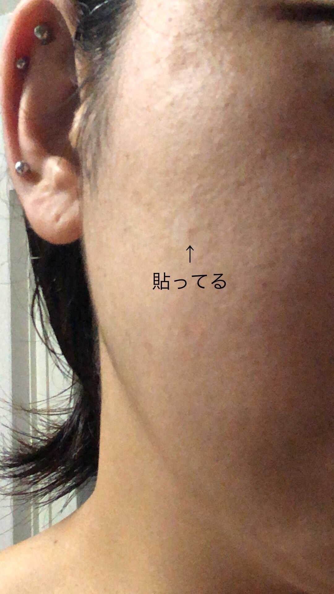 極薄透明パッチ nikipa!/金冠堂/にきびパッチを使ったクチコミ(5枚目)