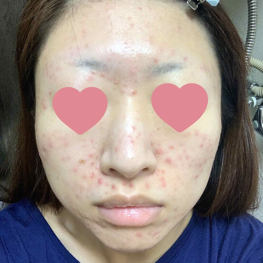 十味敗毒湯(医薬品)/ツムラ/その他を使ったクチコミ(2枚目)