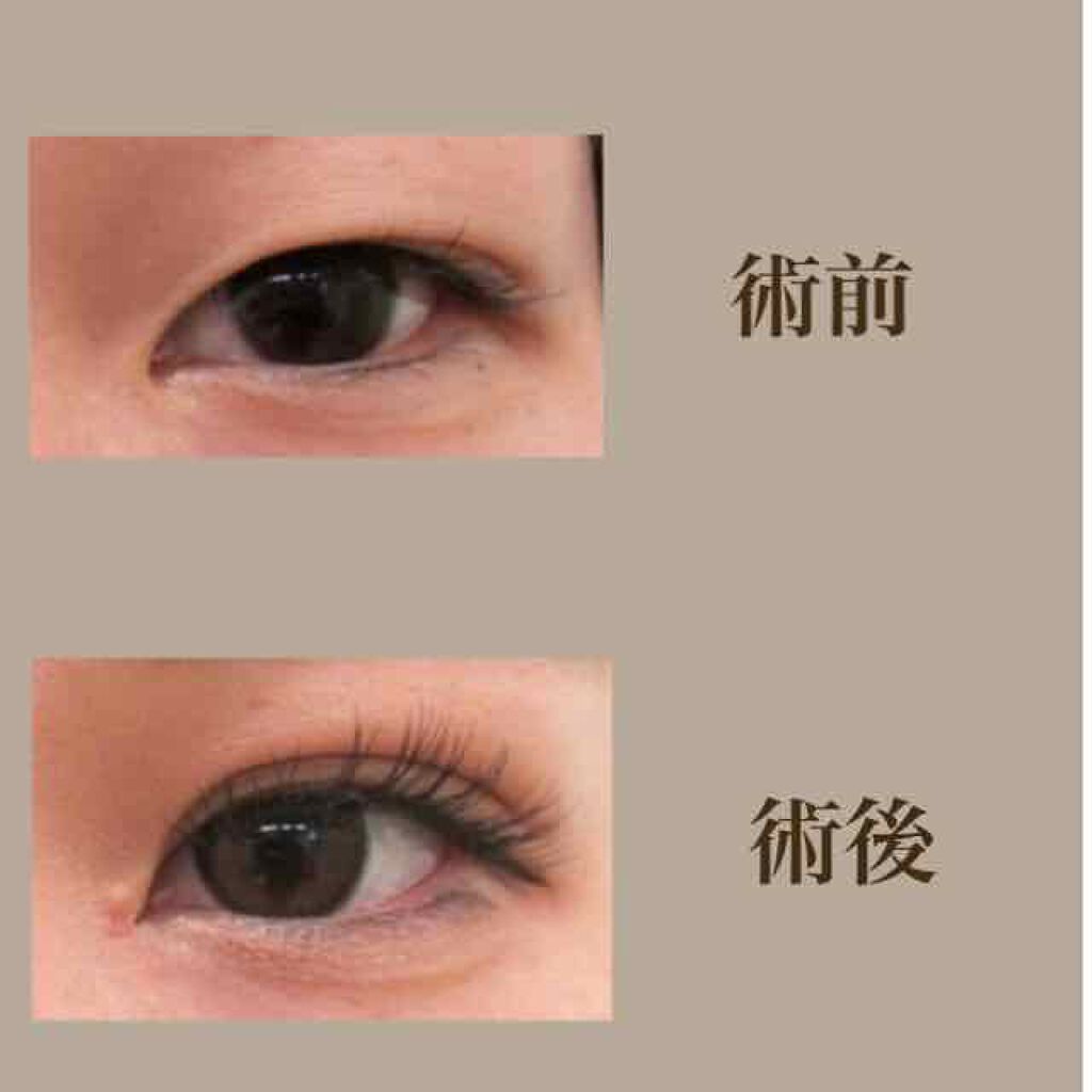 a on LIPS 「約1ヶ月前に念願の二重埋没法と目頭切開法をしました𓂃𓈒𓏸私と同..」(2枚目)