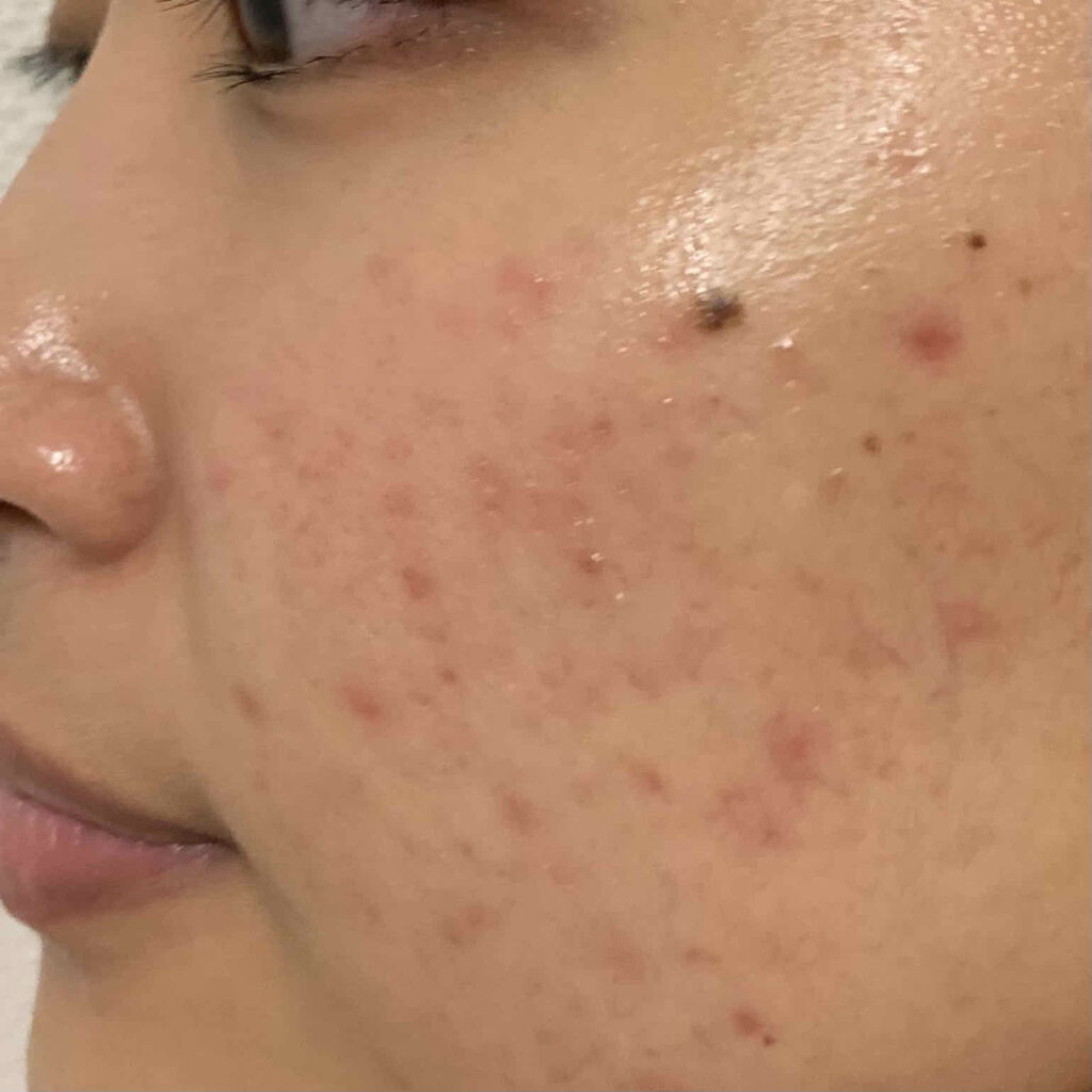 クリアモイスチャー M（しっとりタイプ）/オルビス/乳液を使ったクチコミ（1枚目）