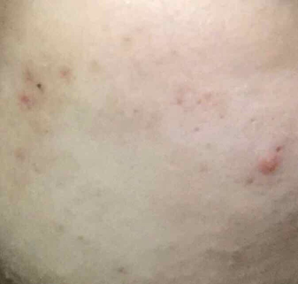 はう on LIPS 「(メラノc使用結果途中報告)こんばんははうです先日、メラノcを..」(3枚目)