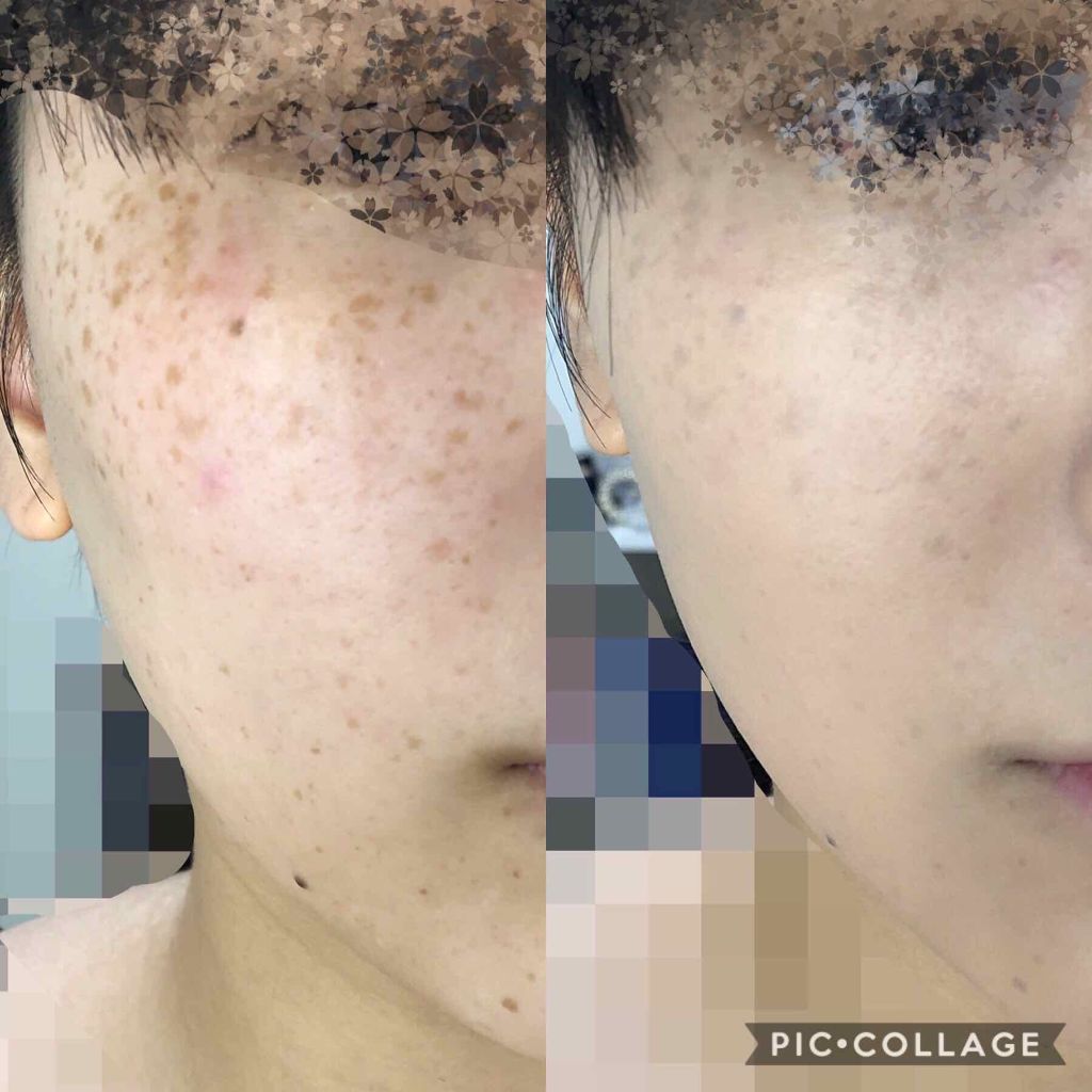 ãã¬ã¹ã¢ããã°ããŠãã¡ã³ããŒã·ã§ã³/ããªããŽã£ã¹ã¿/ã¯ãªãŒã ã»ãšãã«ãžã§ã³ãã¡ã³ããŒã·ã§ã³ã䜿ã£ãã¯ãã³ãïŒ4æç®ïŒ