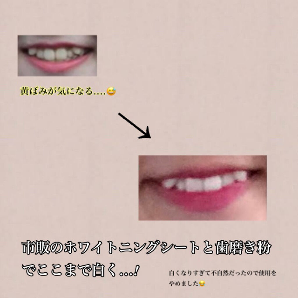 クレスト3Dホワイトニング ホワイトストリップ プロフェッショナル エフェクツ/クレスト/その他オーラルケアを使ったクチコミ（2枚目）