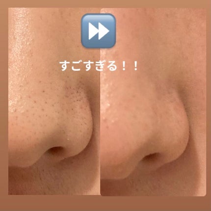 DETクリア ブライト&ピール ピーリングジェリー<無香料タイプ>/Detclear/ピーリングを使ったクチコミ(2枚目)