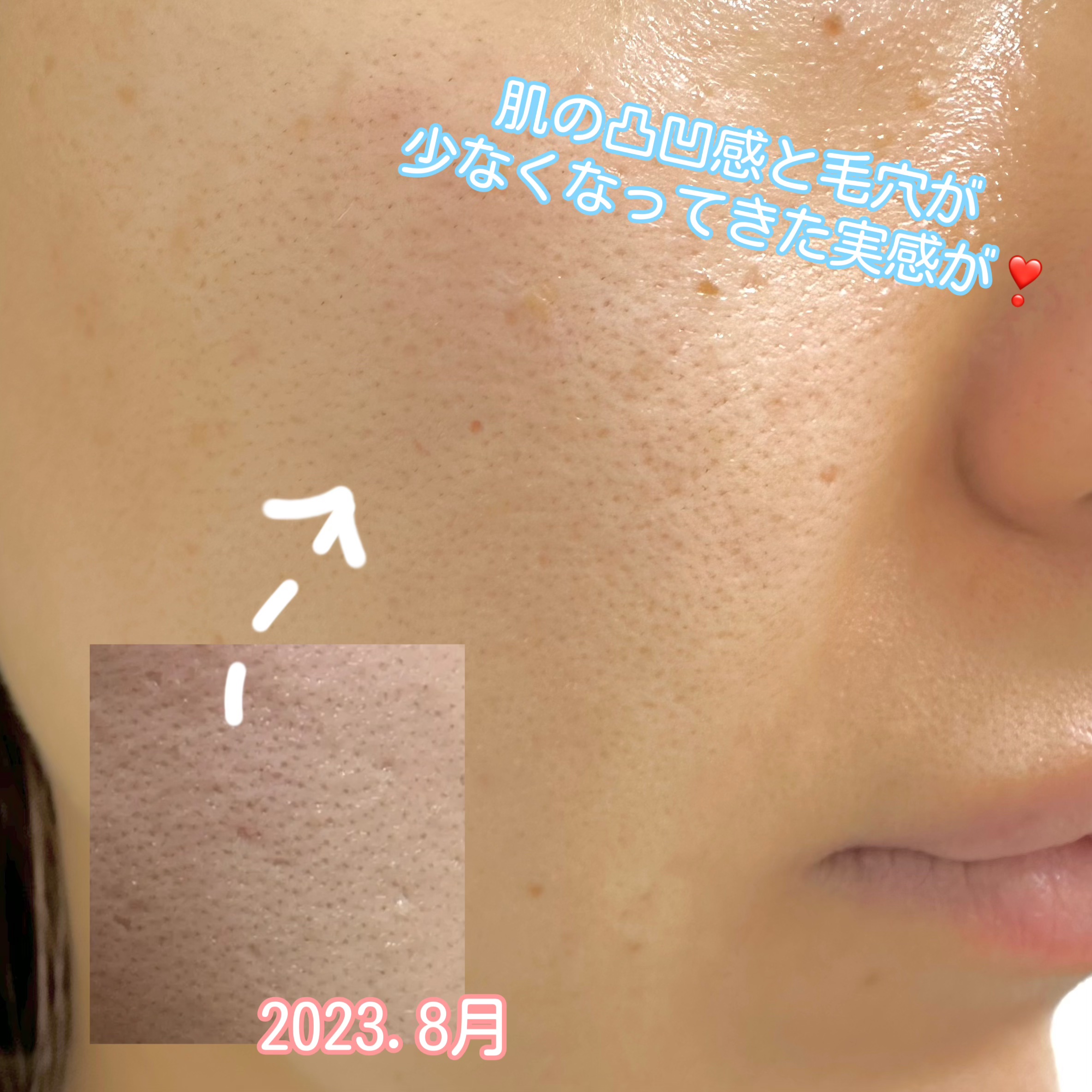 ユース ラディアンス ビタチノール セラム/primera/美容液を使ったクチコミ（3枚目）