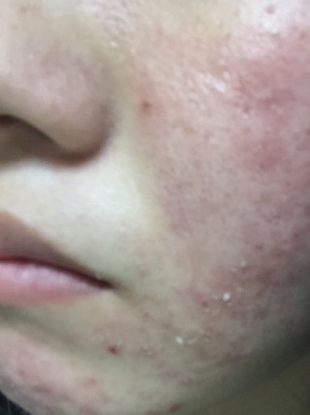 エピデュオゲル/マルホ株式会社/その他を使ったクチコミ（2枚目）