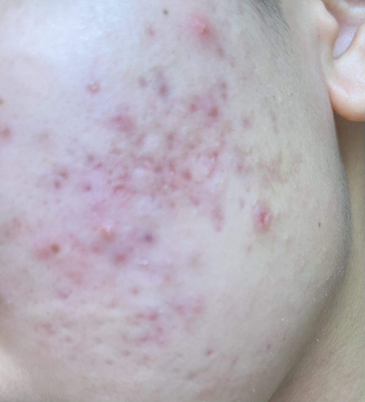 肌をうるおす保湿スキンケア 保湿浸透水モイストリッチのクチコミ「このような肌荒れで悩んでいます。
1ヶ月前、皮膚科に通い始め、ぼこぼこしたニキビはだいぶ減りま.....」（1枚目）