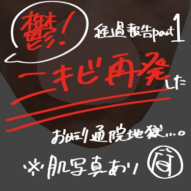 鬱すぎ！！ニキビ再発！！
もういやだーーーーー😭😭

明日から皮膚科通院するので経過報告やろうと思います。

2枚目が今のお肌です。

前回の治療で見違えるほど綺麗になったお肌でしたが、ものの1ヶ月であ