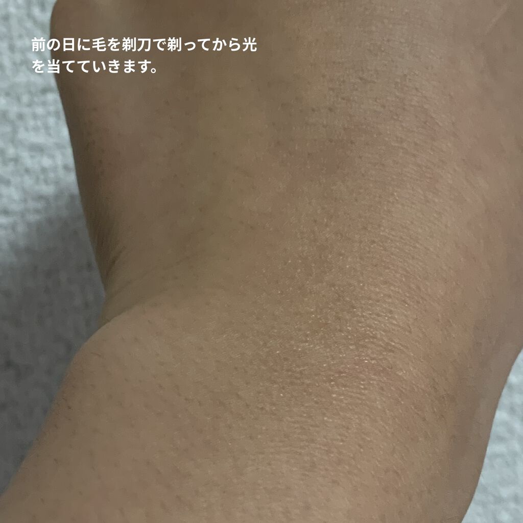 光脱毛器 VIO/Sarlisi/家庭用脱毛器を使ったクチコミ（3枚目）