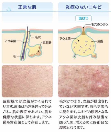 3M™ 人工皮親水性敷料/3M nexcare/その他を使ったクチコミ(4枚目)