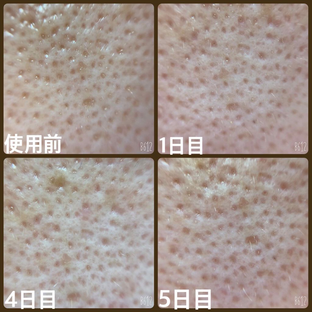 VCスーパー毛穴セラム/ラボラボ/美容液を使ったクチコミ（3枚目）