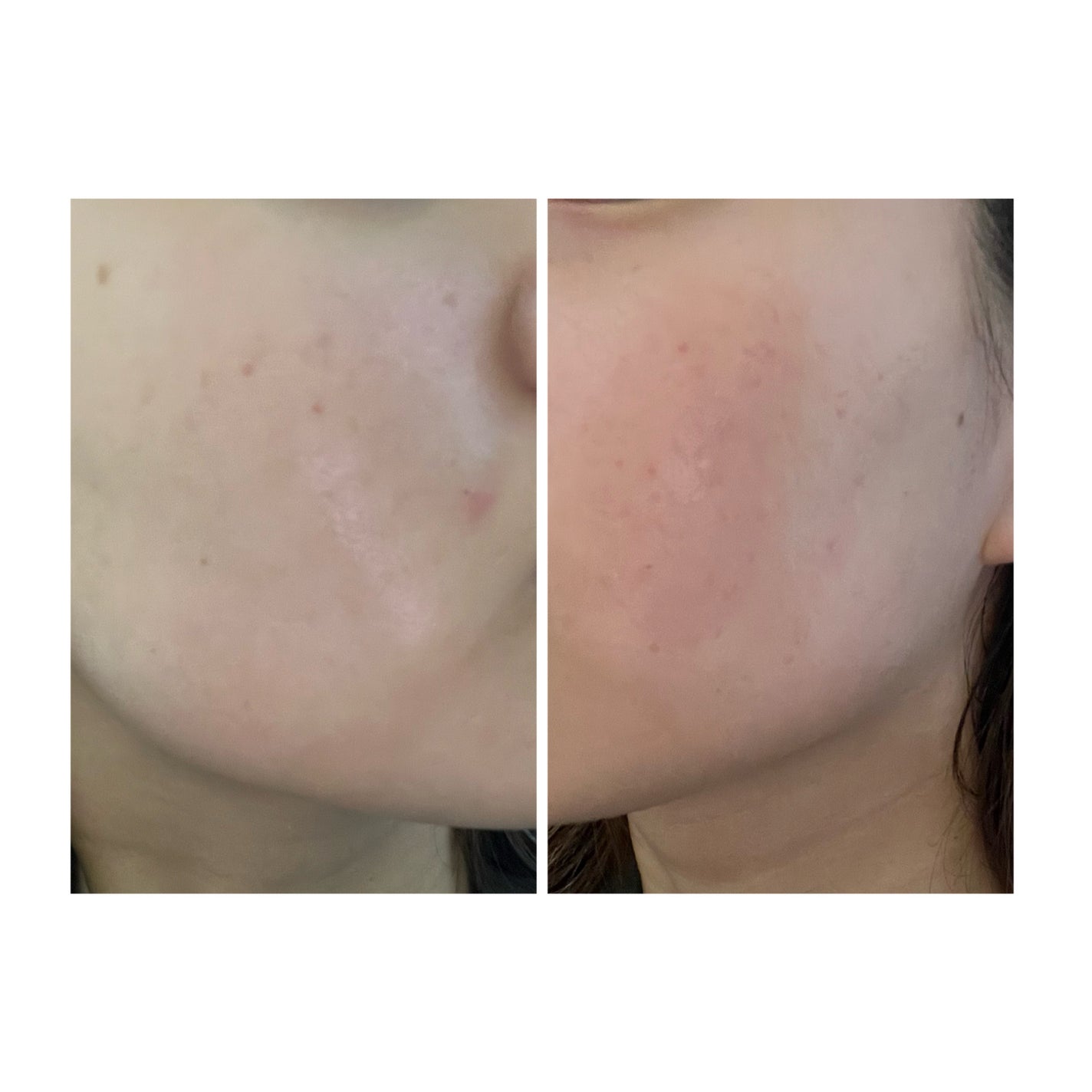 ぽむ on LIPS 「2023.9.13皮膚科に受診 エピデュオとヘパリン処方1枚目..」(4枚目)