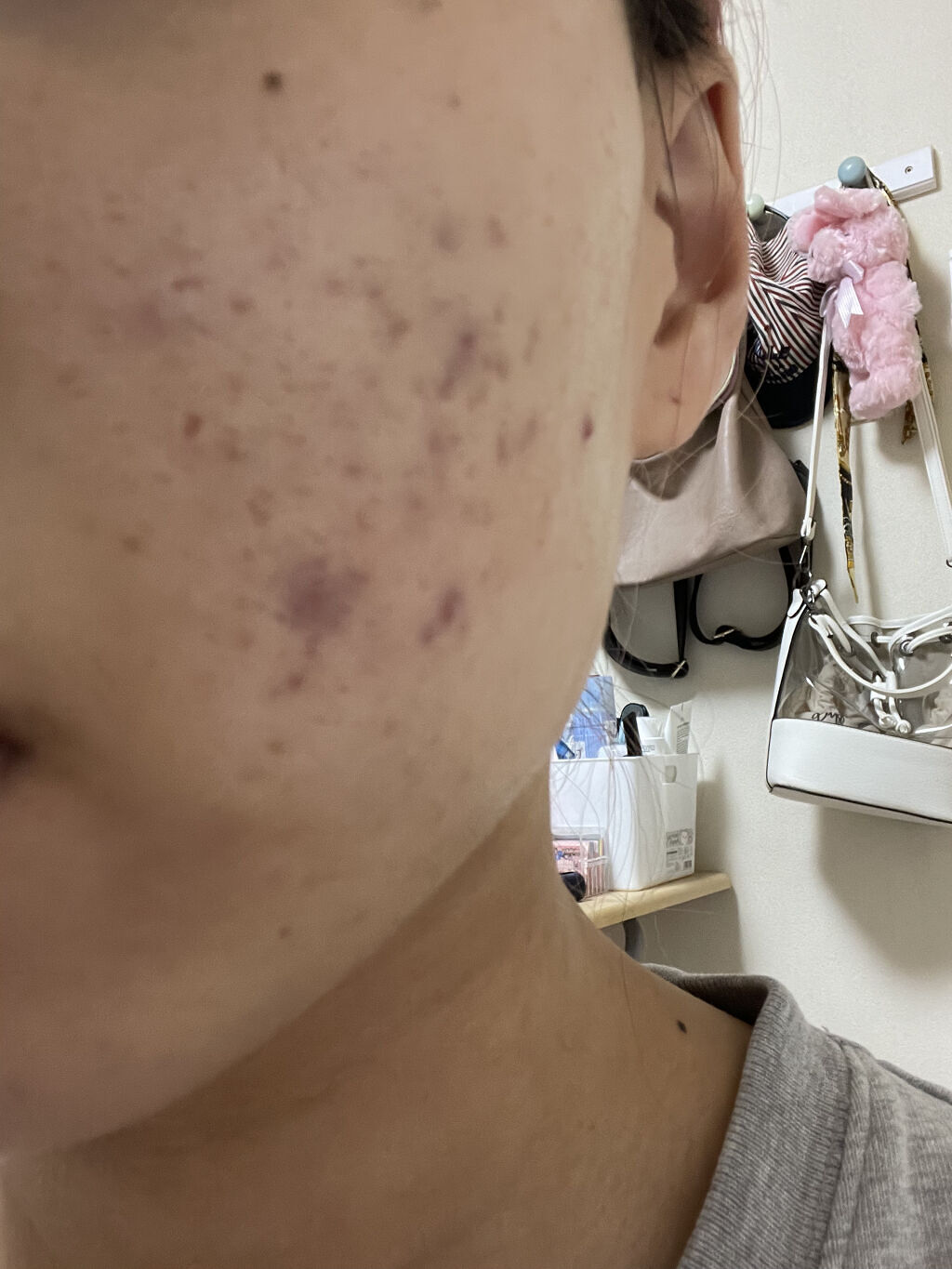 ニキビあとケアジェル/アットノン/その他スキンケアを使ったクチコミ（3枚目）