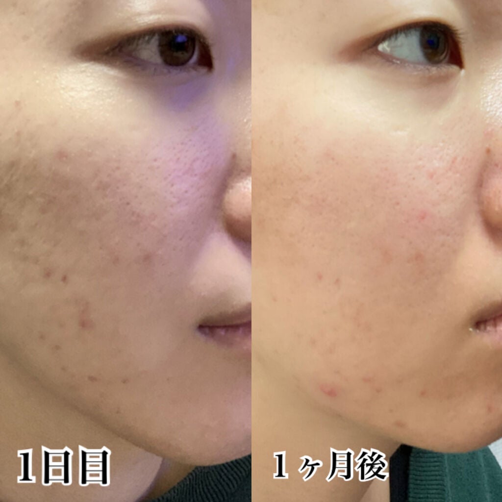 HOTARU PERSONALIZED LOTION/MOISTURIZER /HOTARU PERSONALIZED/スキンケアキットを使ったクチコミ(4枚目)