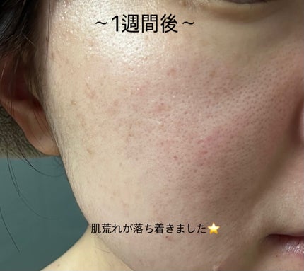 レチノール スーパーバウンス セラム/IOPE/美容液を使ったクチコミ(4枚目)