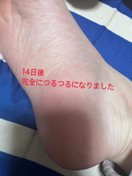 イージーパックDP60分タイプ/ベビーフット/レッグ・フットケアを使ったクチコミ(7枚目)